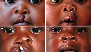 Study shows over 1000 babies are born with cleft lip every year