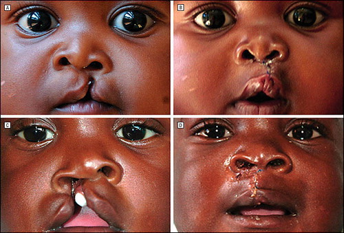 Study shows over 1000 babies are born with cleft lip every year