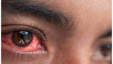 Surge in red eye cases a steady rise to 7,500 within three weeks