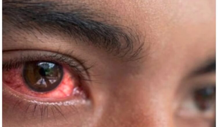 Surge in red eye cases a steady rise to 7,500 within three weeks